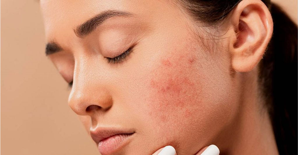 The Hidden Truth Behind Acne